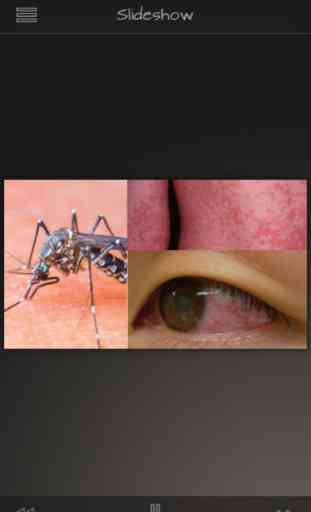 Zika Virus Infection 4