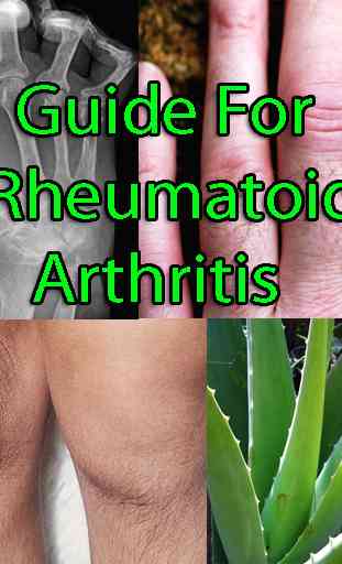 Guide for Rheumatoid Arthritis 1