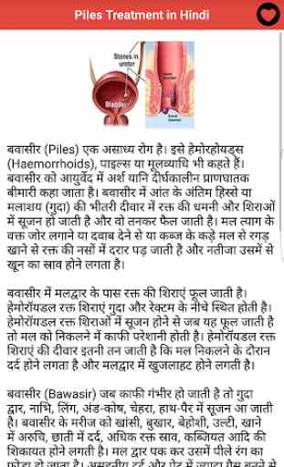 Piles Treatment in Hindi 2