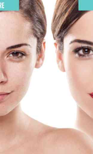 Acne Free : Pimple Remover 2