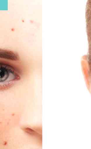 Acne Free : Pimple Remover 3