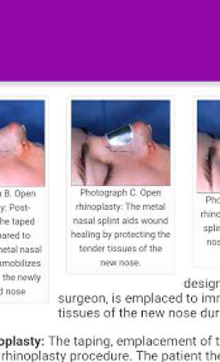 Nose job - Rhinoplasty surgery 4
