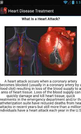 Heart Disease Treatment 4