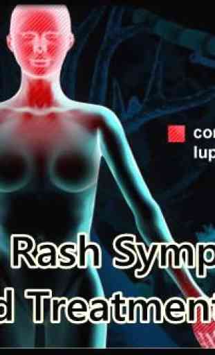 Lupus Rash Symptoms Treatments 2