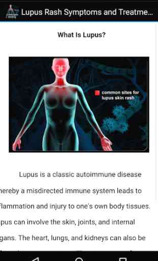 Lupus Rash Symptoms Treatments 3