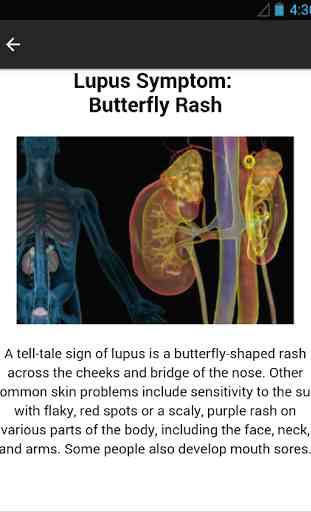 Lupus Symptoms Disease 3