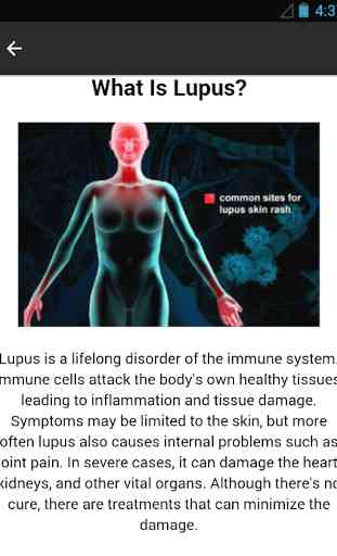 Lupus Symptoms Disease 4