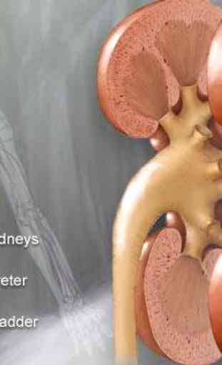 Kidney stone remedy 2