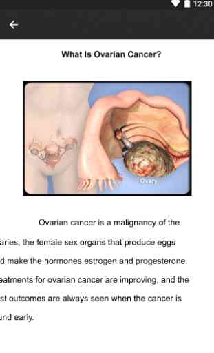 Ovarian Cancer Symptoms 3