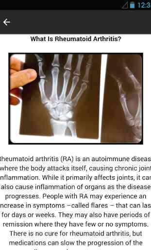 Rheumatoid Arthritis 4