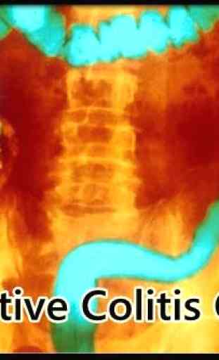 Ulcerative Colitis Causes 2