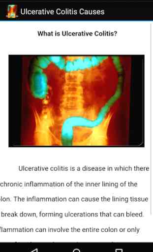 Ulcerative Colitis Causes 3