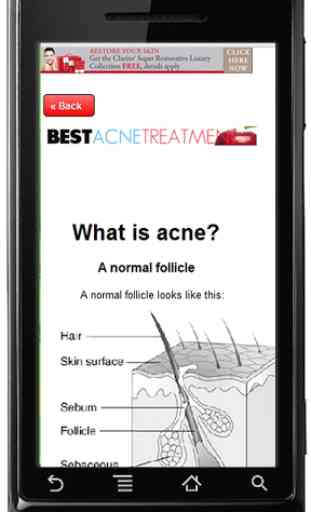 Best Acne Treatment 2