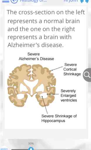 Alzheimer's and Parkinson's Disease by GoLearningBus 1