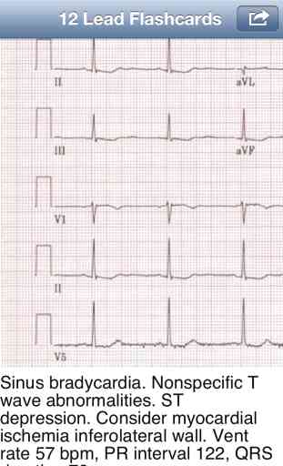 EKG Academy: Electrocardiogram Study Guide 3