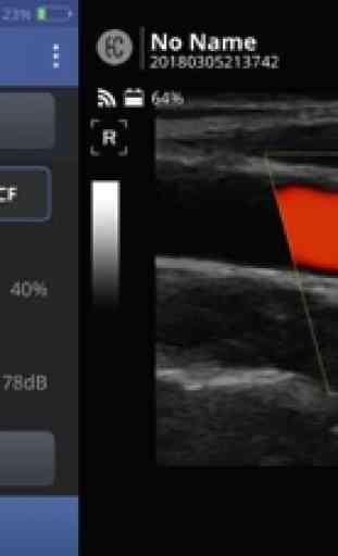 SONON Ultrasound App 1