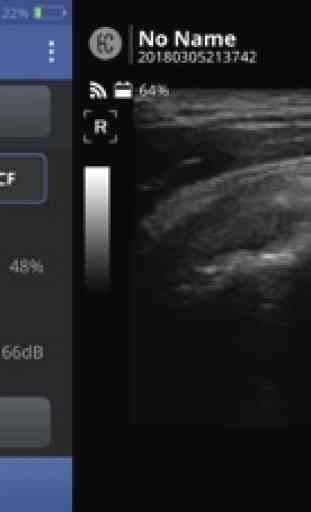 SONON Ultrasound App 2