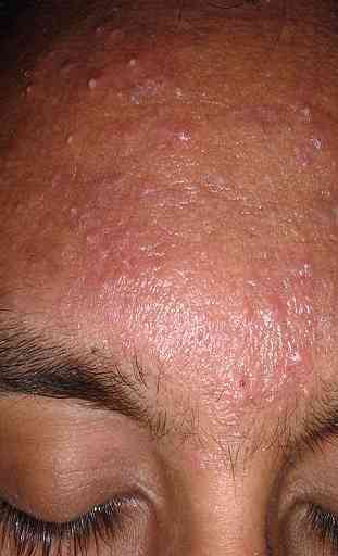 hormonal acne treatment 4