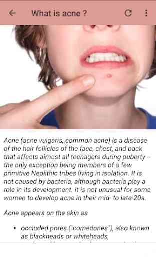 Acne Treatment 2