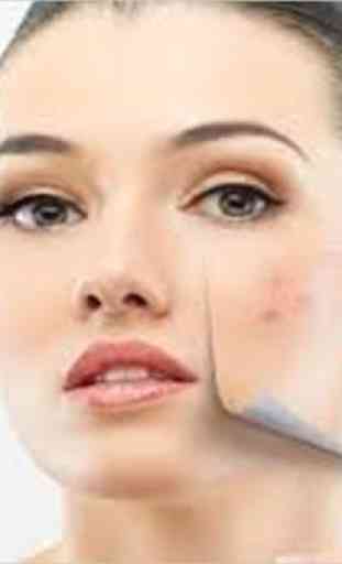Home Remedies For Pimples 2