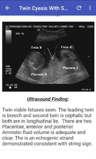 Ultrasound Guide A2Z 1