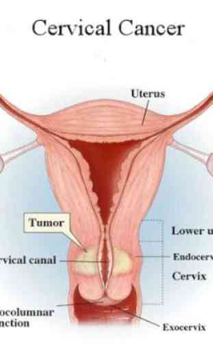 Cervical Cancer 4