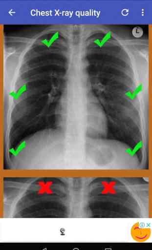 Chest X-Ray Interpretation - A basic guid 3