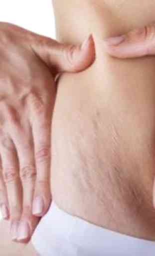 Natural Stretch Marks Removal 3