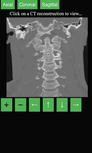 CT Cervical Spine 2