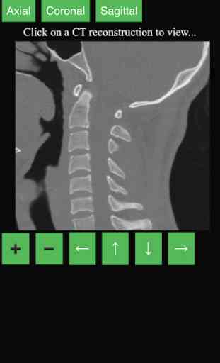 CT Cervical Spine 3
