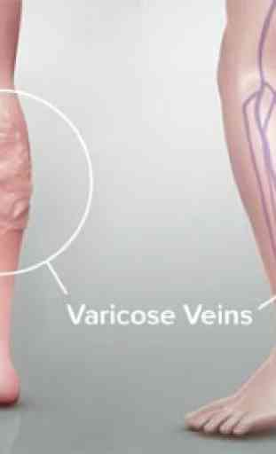 varicose veins guide 1