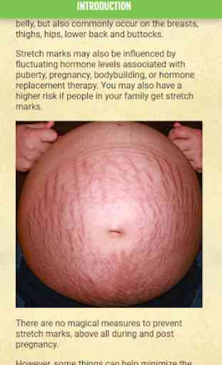 Get rid of STRETCH MARKS - Home Remedies 2