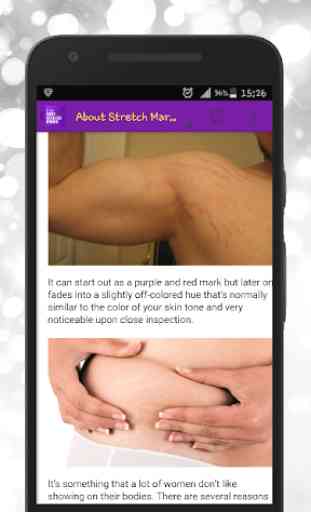 Get Rid of Body Stretch Marks Naturally 2