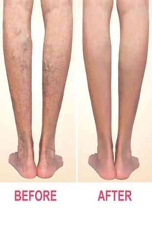 Sclerotherapy 2