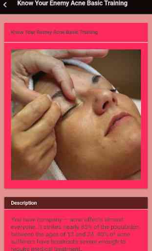 Acne Treatment Guide 3