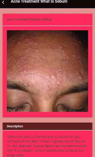 Acne Treatment Guide 4