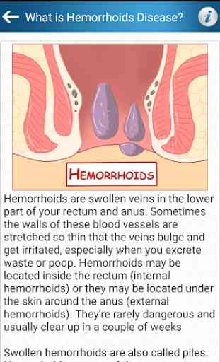 Hemorrhoids Piles Help Prevention Foods Diet Tips 2