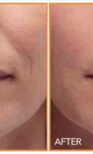Reduce Wrinkles Naturally - Look Younger Instantly 3