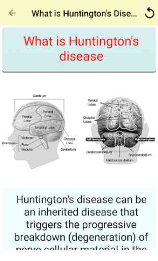 Huntington's Disease 3