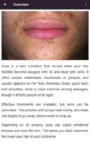 Acne Treatments & Remedies 2