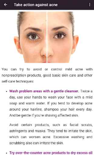 Acne Treatments & Remedies 3