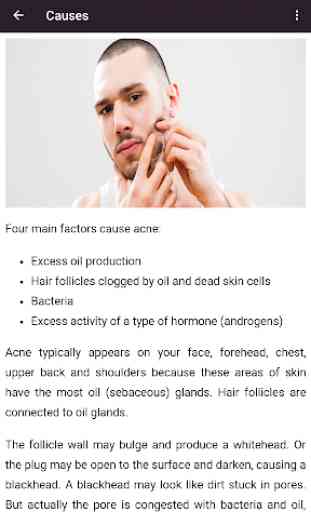 Acne Treatments & Remedies 4