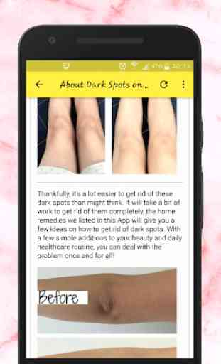 Get Rid Of Dark Spots on Knees and Elbows at Home 2