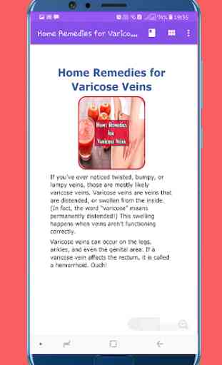 Home Remedies for Varicose Veins 2