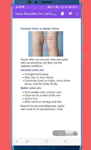 Home Remedies for Varicose Veins 3