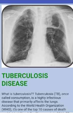 Tuberculosis Disease 3