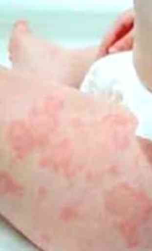 Hives in Babies Tips 1