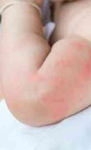 Hives in Babies Tips 2