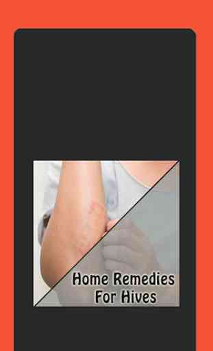 Home Remedies For Hives 1