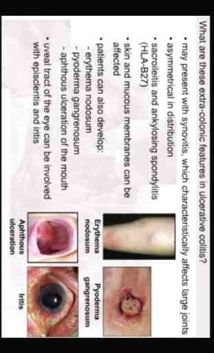 AnswersIn Ulcerative Colitis 3